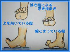 浮き指images