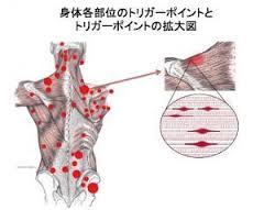 trigger point